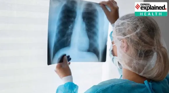 How novel initiative helped Tamil Nadu bring down TB deaths in the state Tamil News