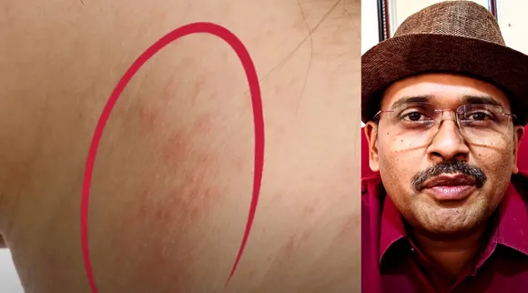 skin cancer