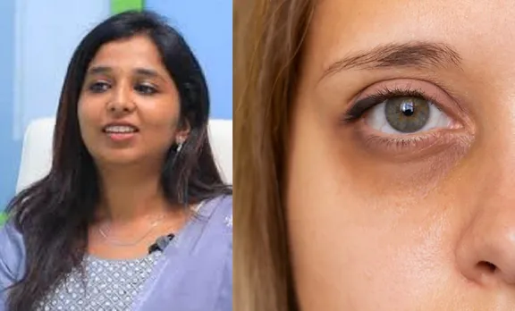 Dark circles Home remedies