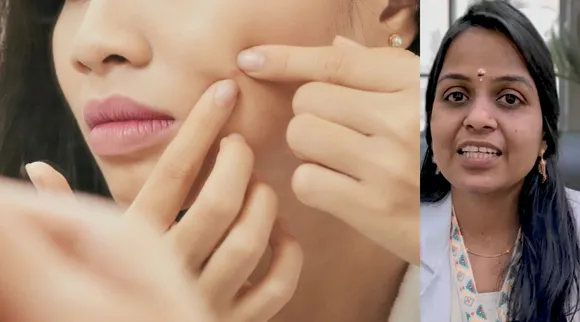 pimples