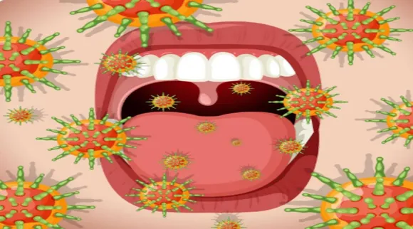 Tongue cancer