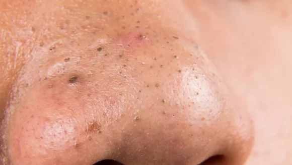 black heads