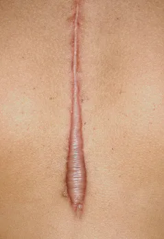 scar