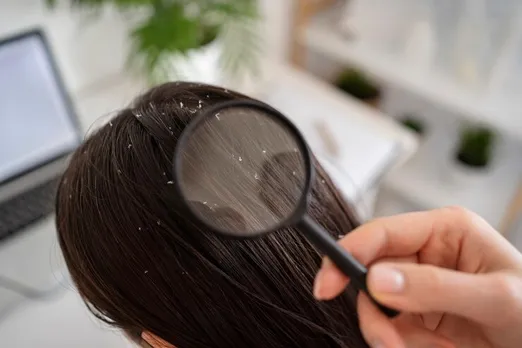 Dandruff Ayurveda remedy 