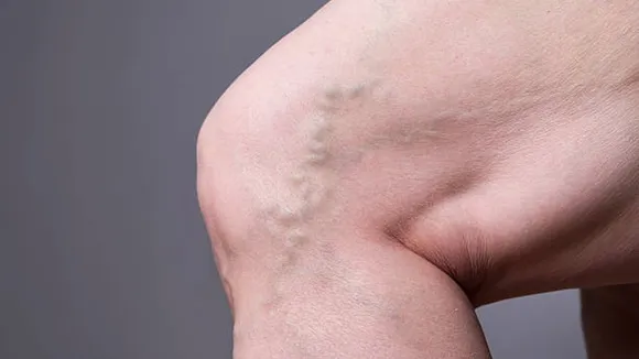 varicose veins