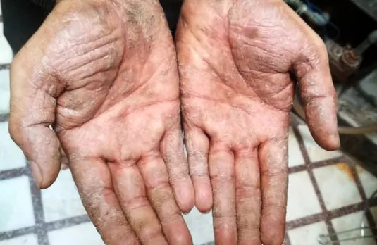 psoriasis