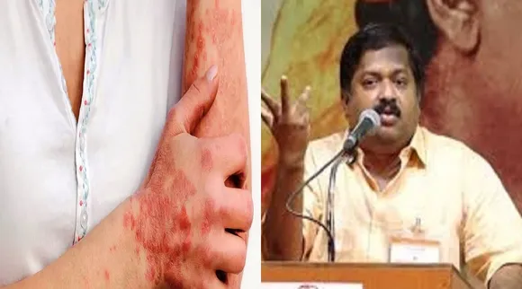 Psoriasis Sivaraman