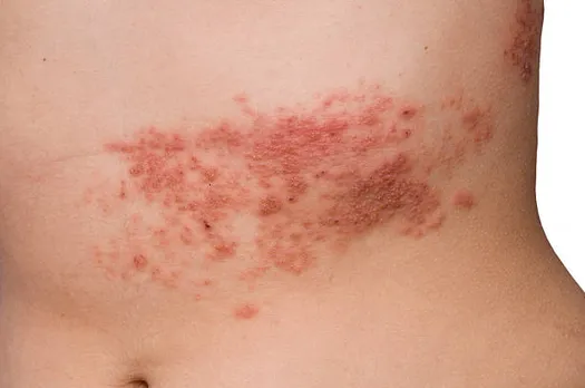 skin rashes