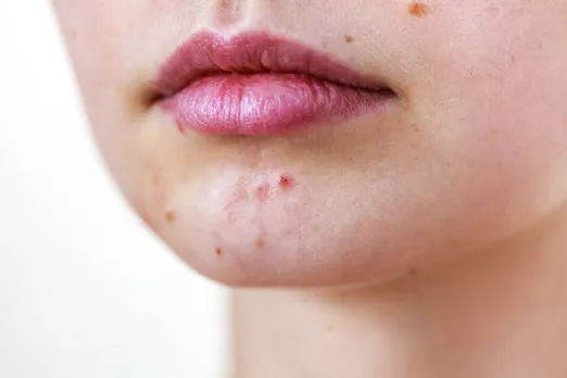 acne