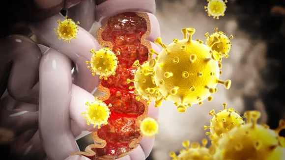 colon cancer