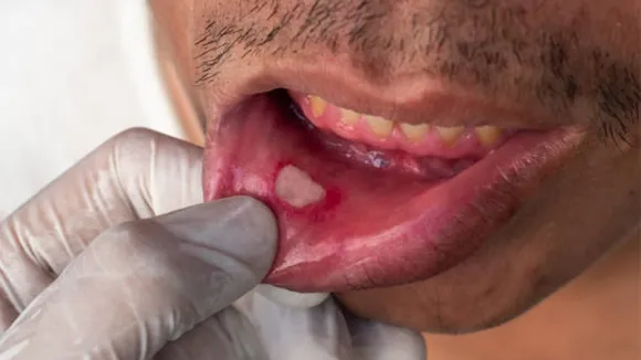 mouth ulcer