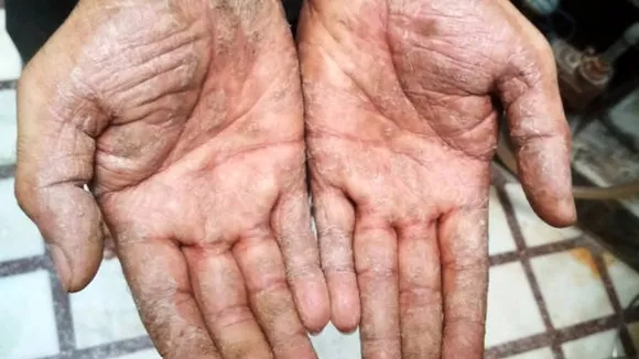 psoriasis