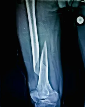 bone health