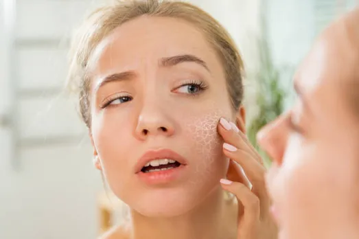 dry skin