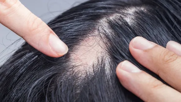 alopecia