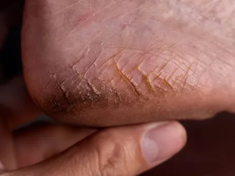 cracked heel