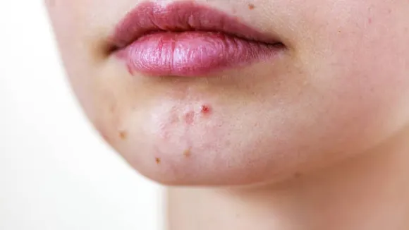 acne