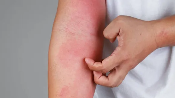skin rashes