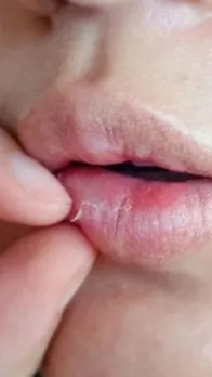 dry lips in summer home remedies
