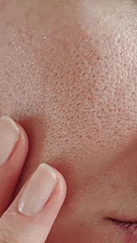 Natural Ways to Close Open Pores 10 Face Packs That Actually Work
