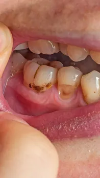 This Tropical Fruit Contains a Powerful Enzyme That May Help Remove Dental Plaque
