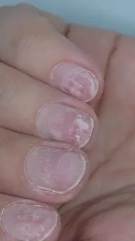 weak-nails