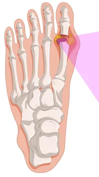 High uric acid symptoms