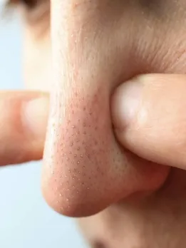 ओपन पोर्स से छुटकारा पाने के लिए अपनाएं ये टिप्स