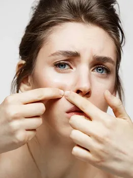 व्हाइटहेड्स से छुटकारा पाने के लिए अपनाएं ये घरेलू नुस्खे