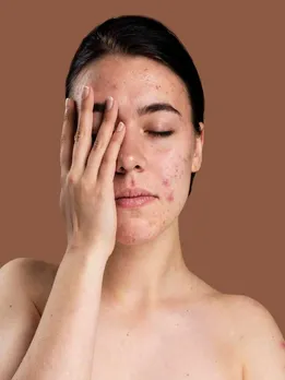 Cystic Acne से छुटकारा पाने के लिए अपनाएं ये घरेलू नुस्खे