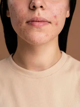 चेहरे से डार्क स्पॉट हटाने के बेहतरीन नुस्खे