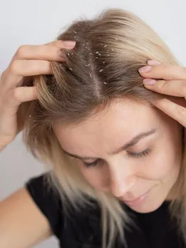 ऑयली डैंड्रफ से छुटकारा पाने के लिए अपनाएं ये टिप्स
