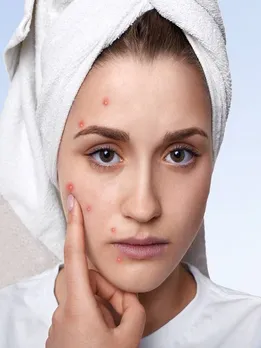 चेहरे पर निकल गए हैं दाने, इन घरेलू नुस्खे से पाएं छुटकारा