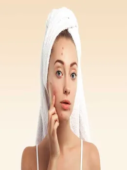 मानसून में पिंपल्स को दूर करने के घरेलू उपाय