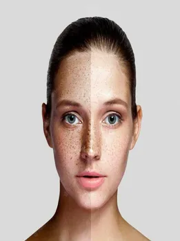 झाइयों को कम करने के लिए ऐसे करें ग्रीन-टी का इस्तेमाल