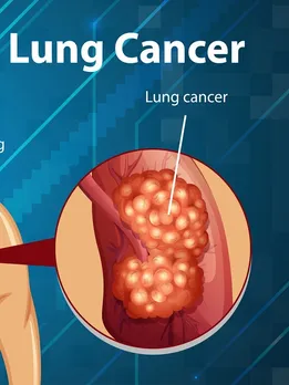 Lung Cancer Awareness: लंग कैंसर से बचाव के लिए फॉलो करें ये टिप्स