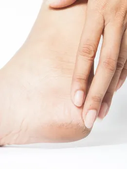 सर्दियों में फटी एड़ियों को ठीक करने के लिए अपनाएं ये घरेलू नुस्खे
