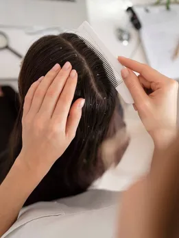 Winter Care Tips: डैंड्रफ की समस्या से हैं परेशान तो आजमाएं दादी-नानी के ये घरेलू नुस्खे
