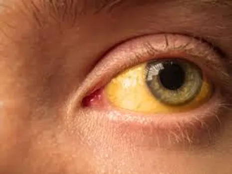 hepatitis a