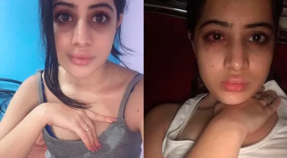 OMG! Urfi Javed Reveals Having Lip Fillers From The Age Of 18; See Pictures —