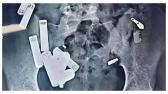Batteries in stomach