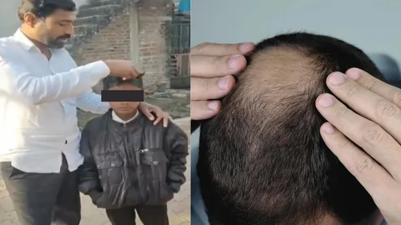 Buldhana hair loss