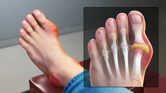 Gout attack (Courtesy: Wikipedia)