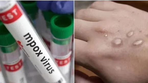 Monkey pox Monkeypox 