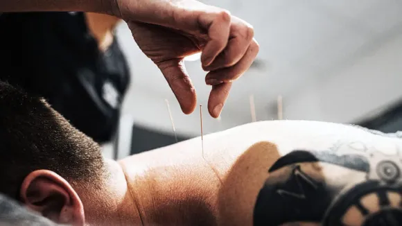 Acupuncture