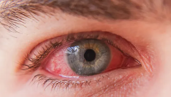 syphilis of the eye.jpg