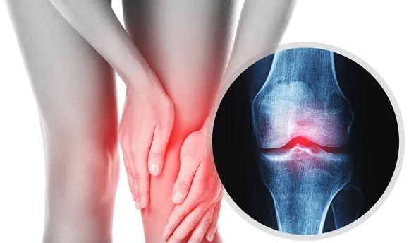 Osteoarthritis.jpeg