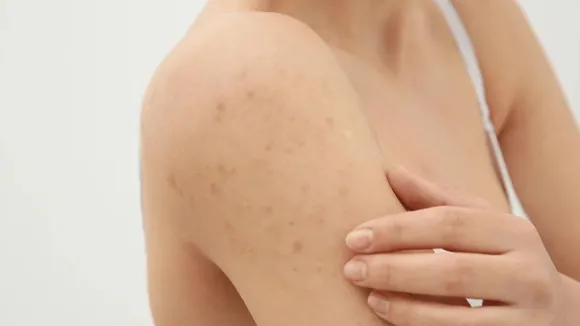 NSW scabies outbreak