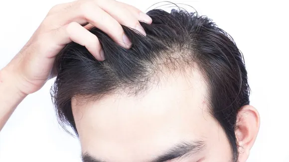 hair loss 