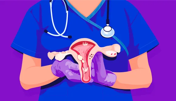 ovarian cancer